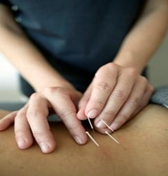 Acupuncture Acupuncture